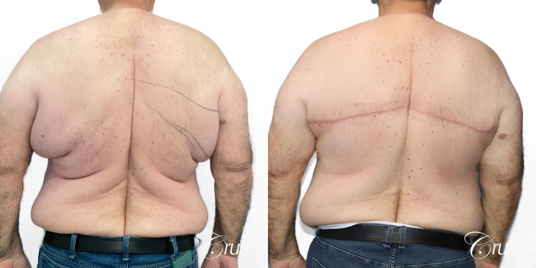 Gynecomastia: Patient 147 - Before and After 4