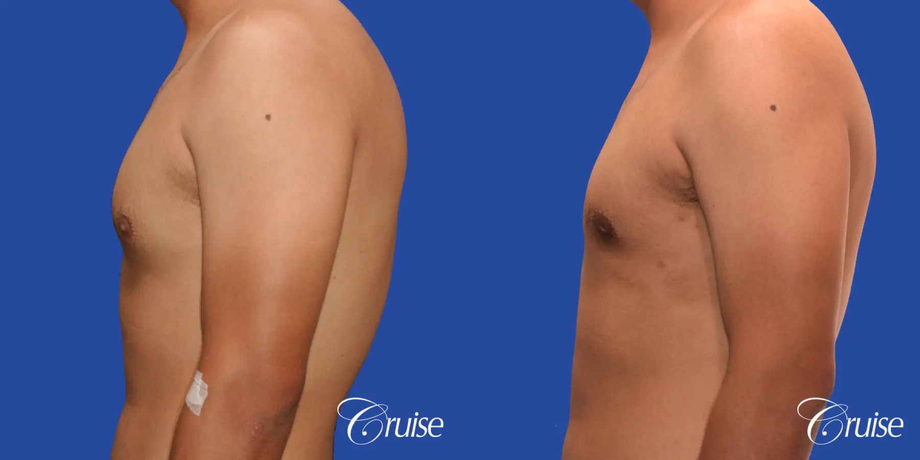 mild gynecomastia standard PA areola incision - Before and After 2
