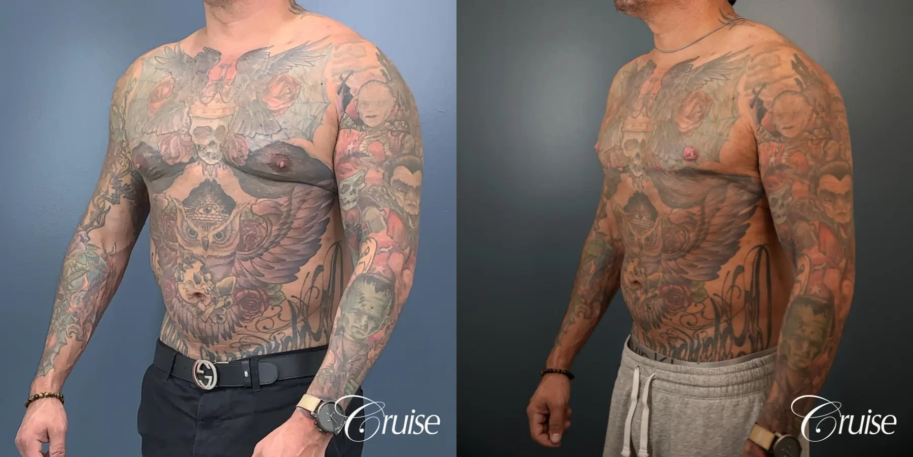Gynecomastia: Patient 136 - Before and After 2