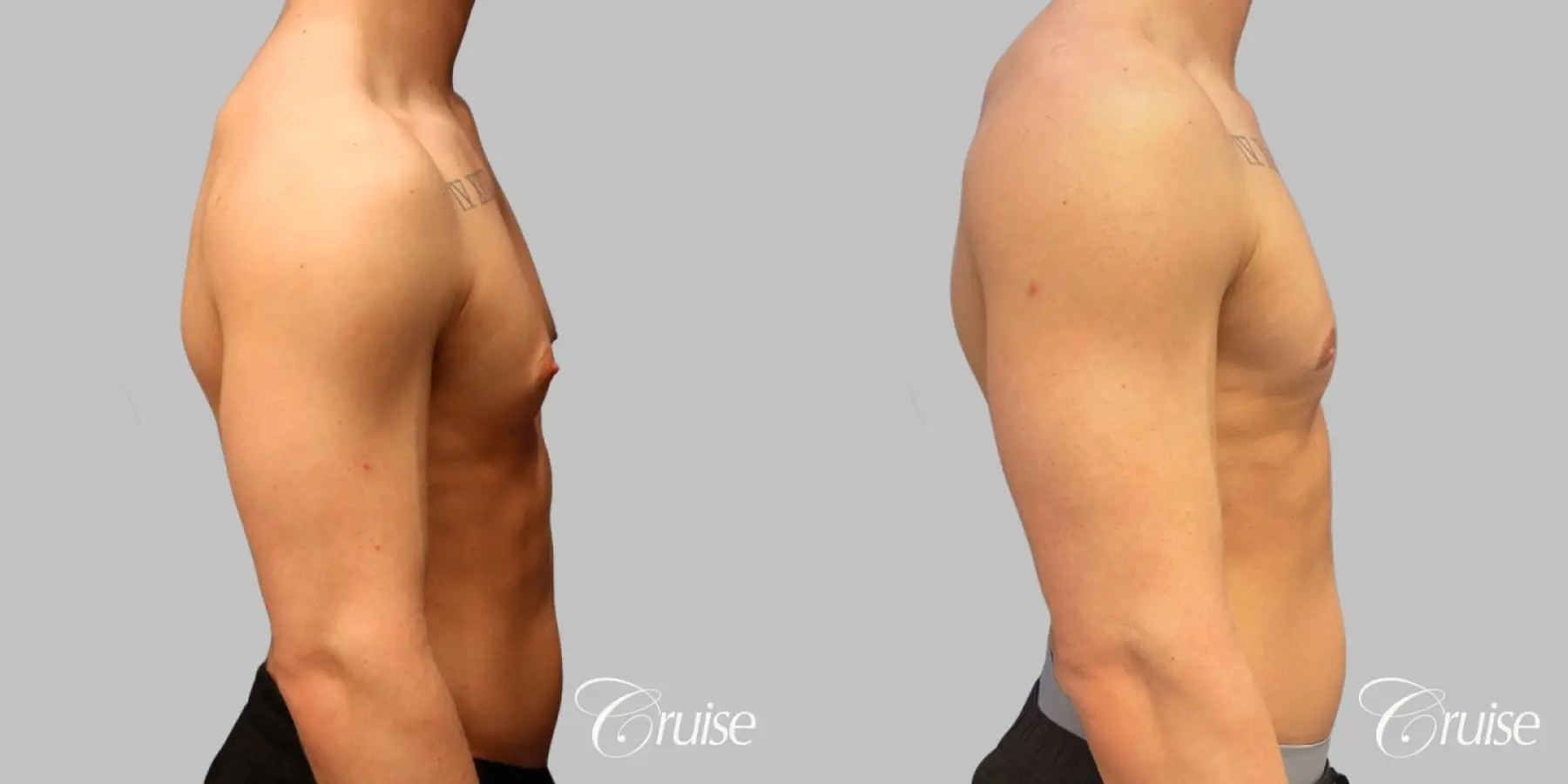Gynecomastia Type 1 Inferior Crescent - Before and After 3