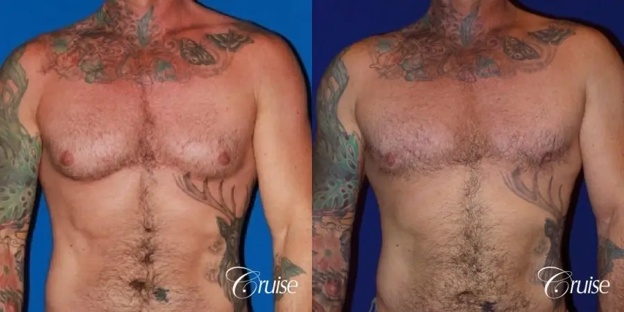 adult gynecomastia - Before and After 1