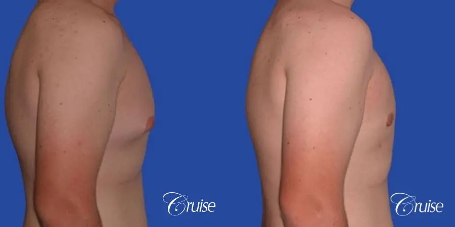 mild gynecomastia with puffy nipple from puberty - Before and After 2