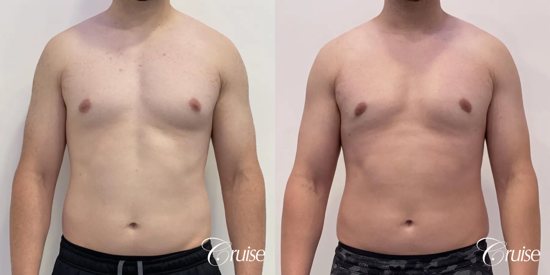 Gynecomastia: Patient 129 - Before and After 1