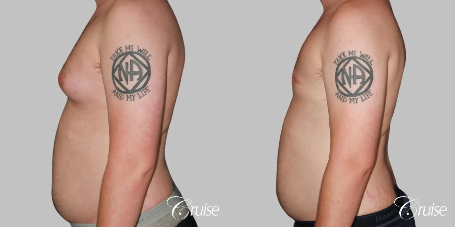 asymmetric gynecomastia moderate - Before and After 4