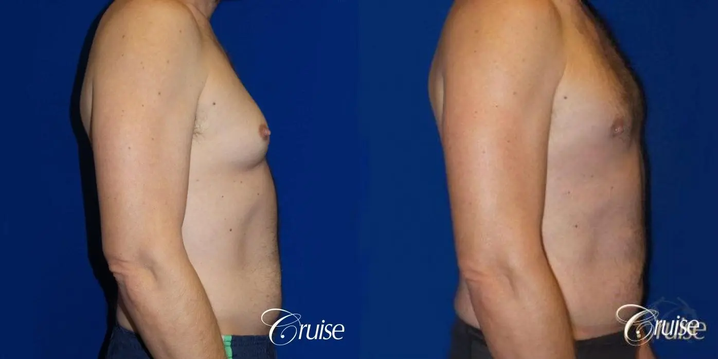 Best Gynecomastia surgeons Los Angeles - Before and After 3