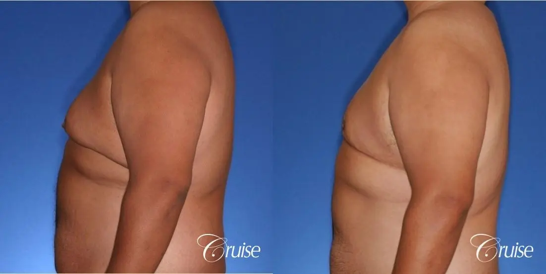 free nipple graft gynecomastia results - Before and After 3