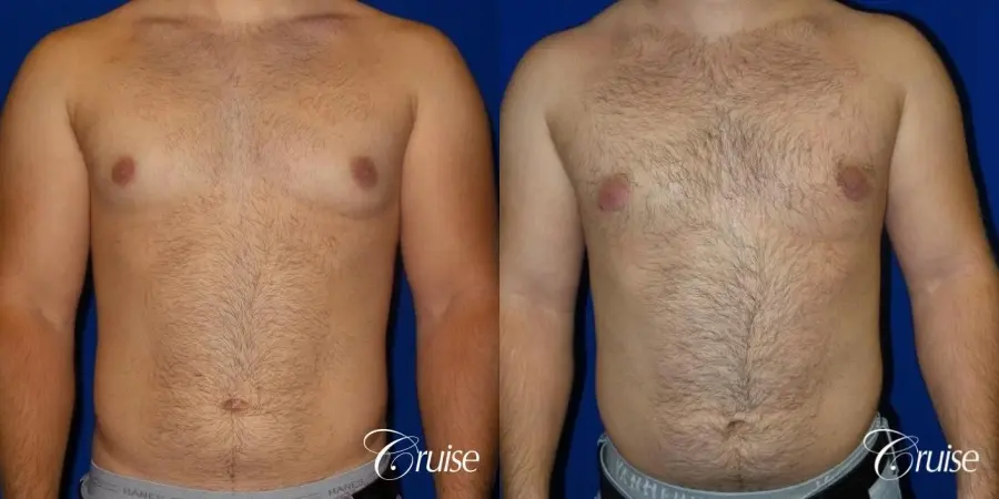 best gynecomastia results - Before and After 1