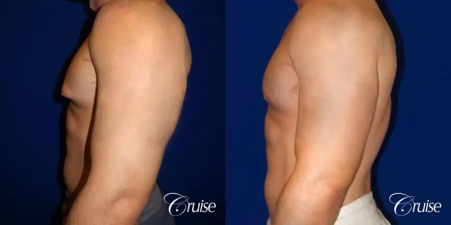 Pictures of young bodybuilder with puffy nipples - Before and After 3