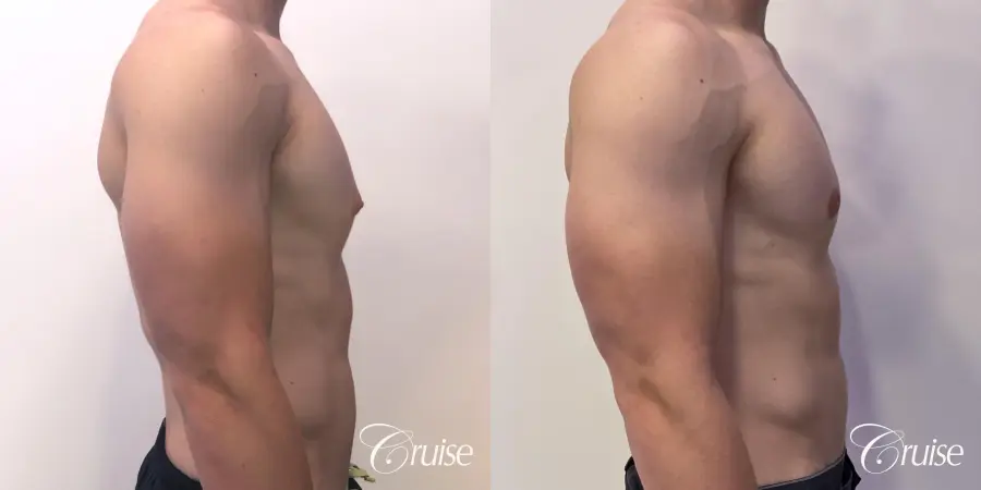 gynecomastia with puffy nipples - Before and After 4