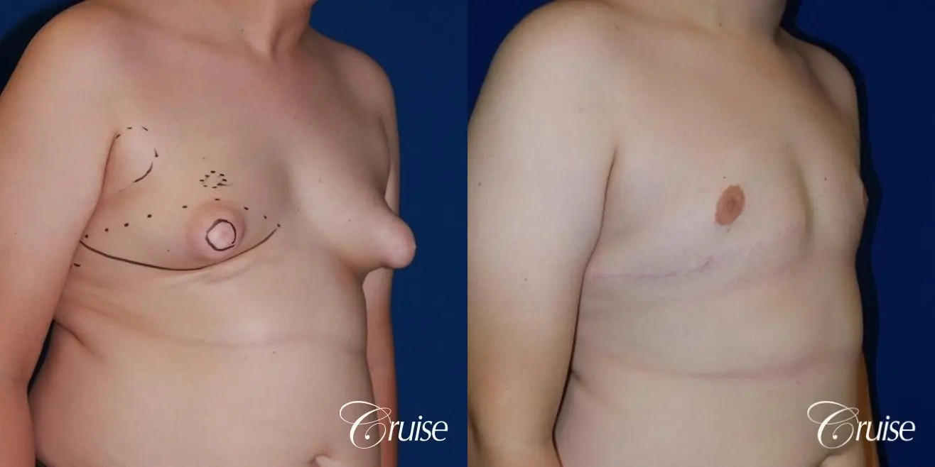 before after young nude 