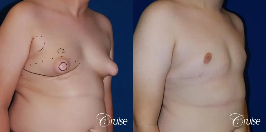 young boy with gynecomastia during puberty gets surgery - Before and After 3