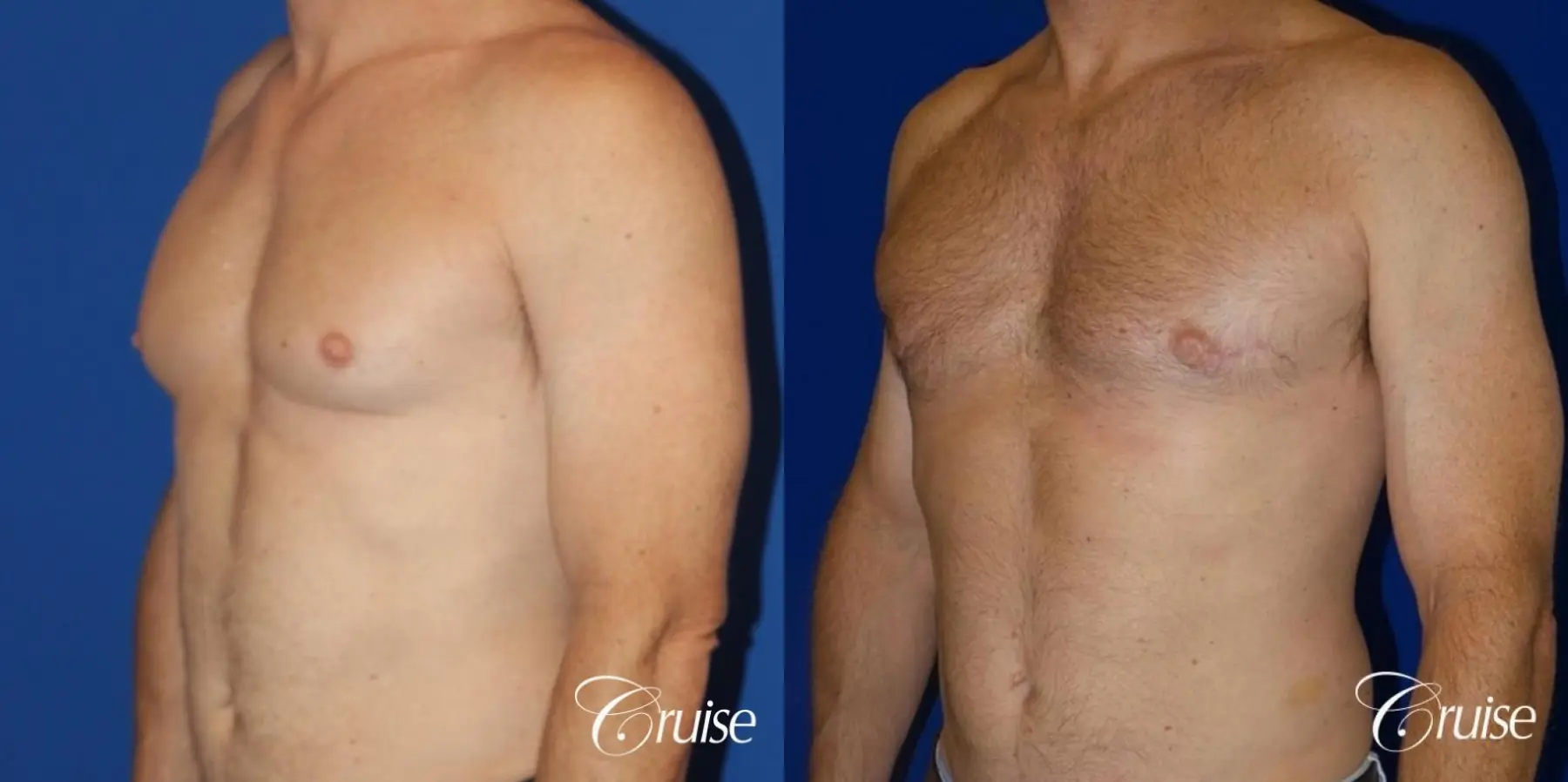 best gynecomastia results on 45 year old - Before and After 2