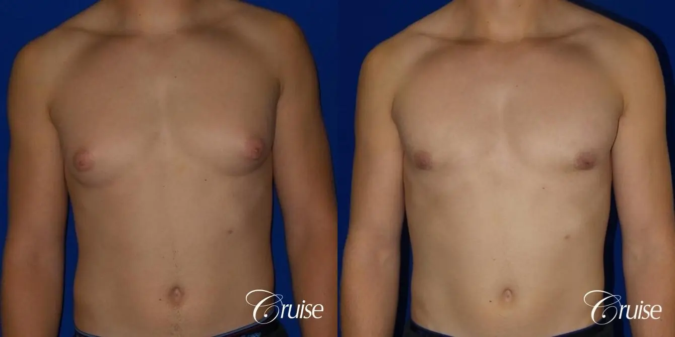 Mild Gynecomastia -Areola Incision - Before and After  