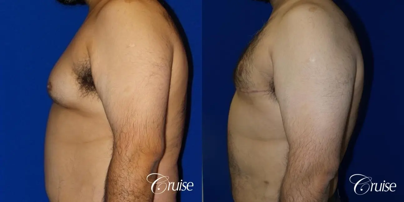 Type 4.5 Gynecomastia Free Nipple Graft - Before and After 3