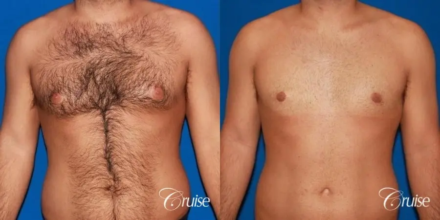 moderate gynecomastia on adult - Before and After 1