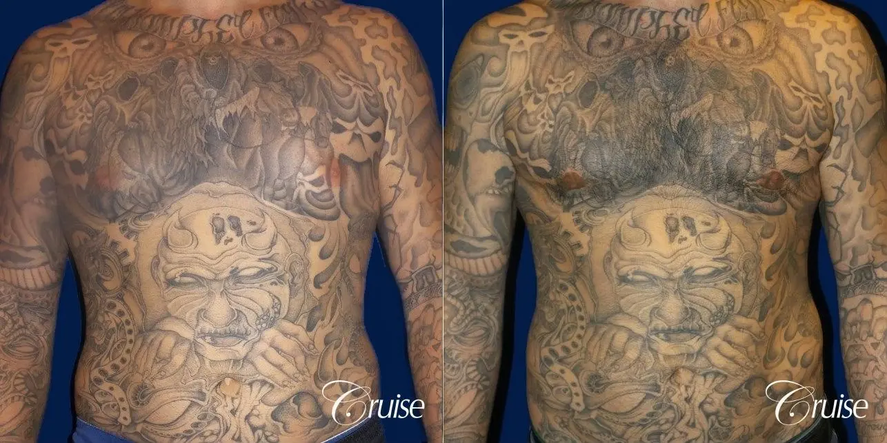 Moderate Gynecomastia Areola Incision - Before and After 1