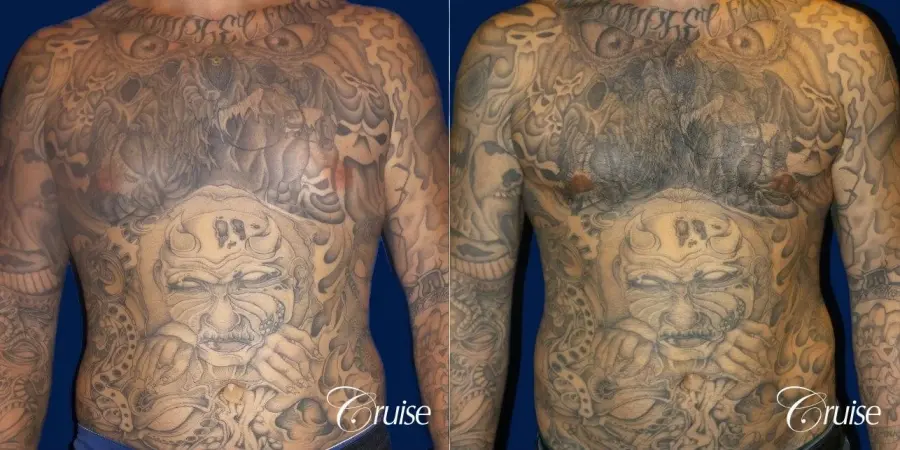 Moderate Gynecomastia Areola Incision - Before and After 1