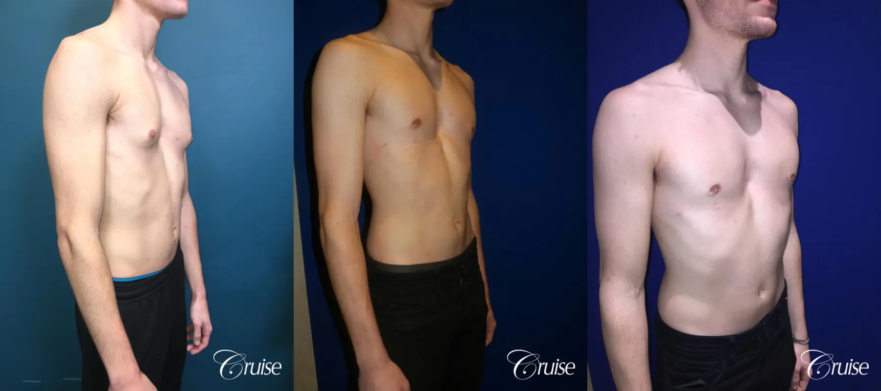 Gynecomastia: Patient 161 - Before and After 2