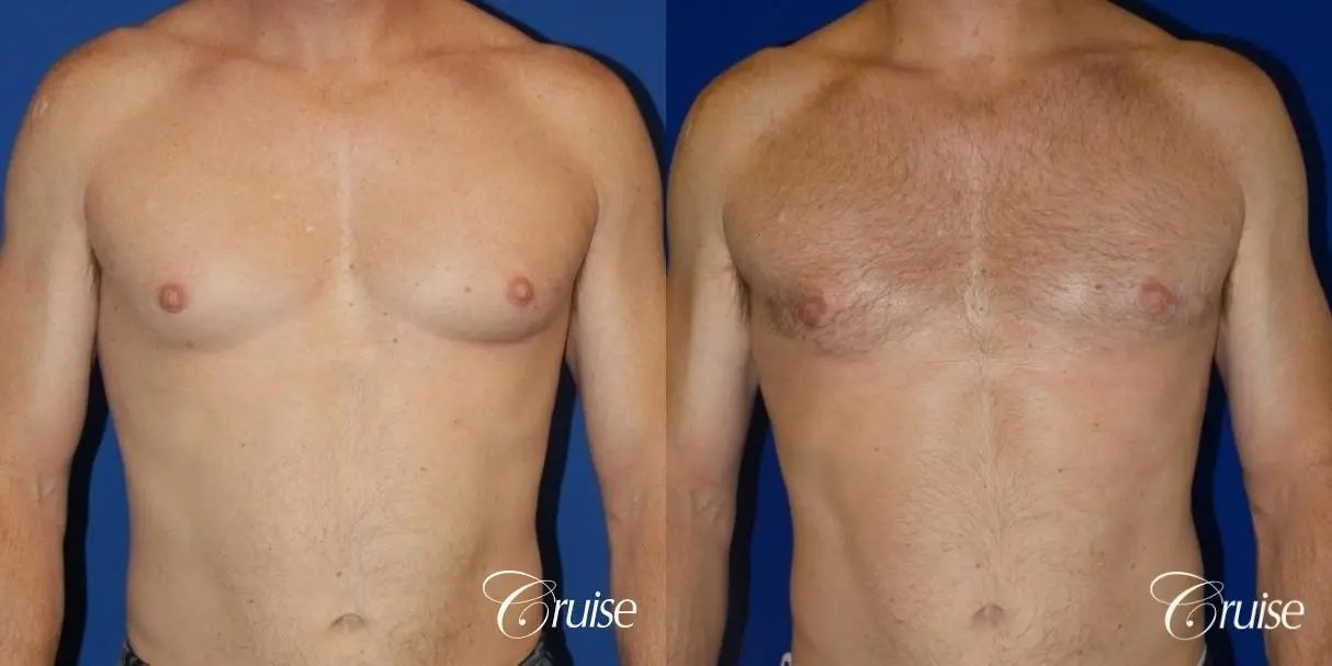 best gynecomastia results on 45 year old - Before and After 1