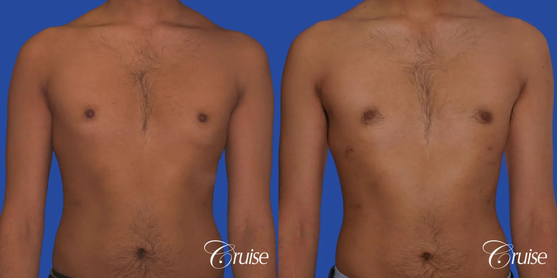 best before and after results for gynecomastia surgery - Before and After 1