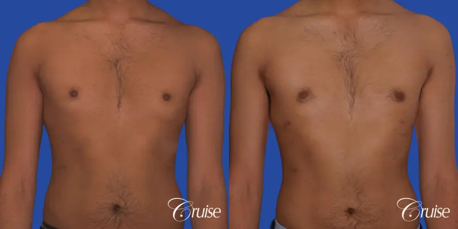 best before and after results for gynecomastia surgery - Before and After 1