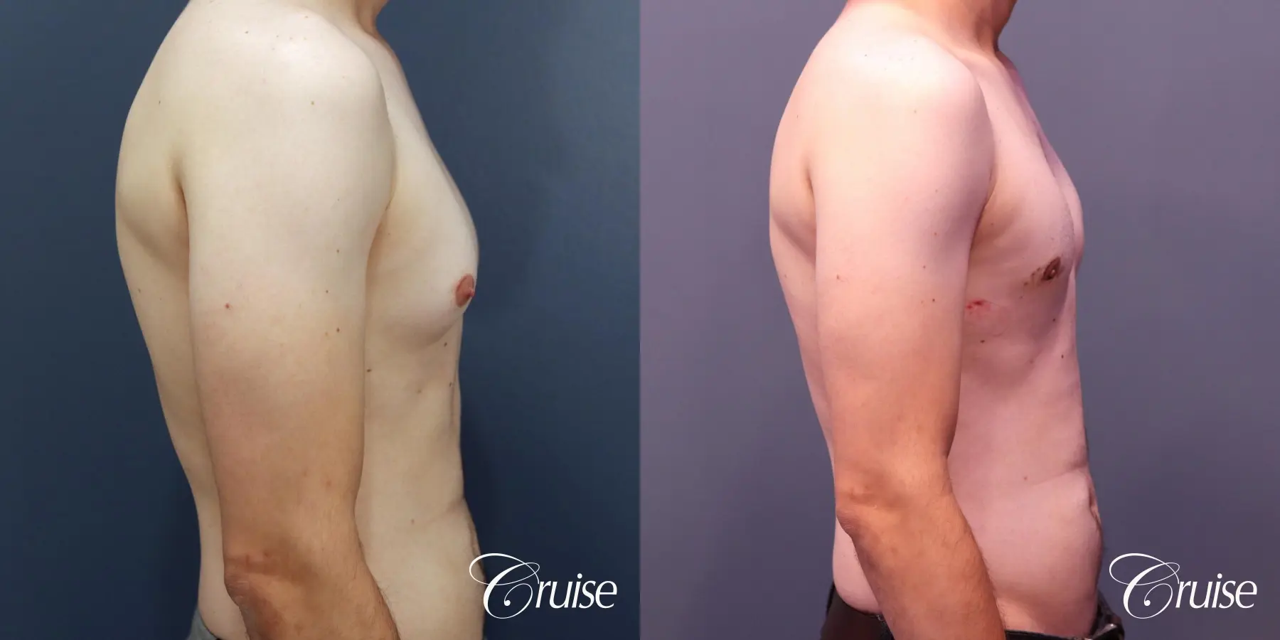 Gynecomastia: Patient 138 - Before and After 5