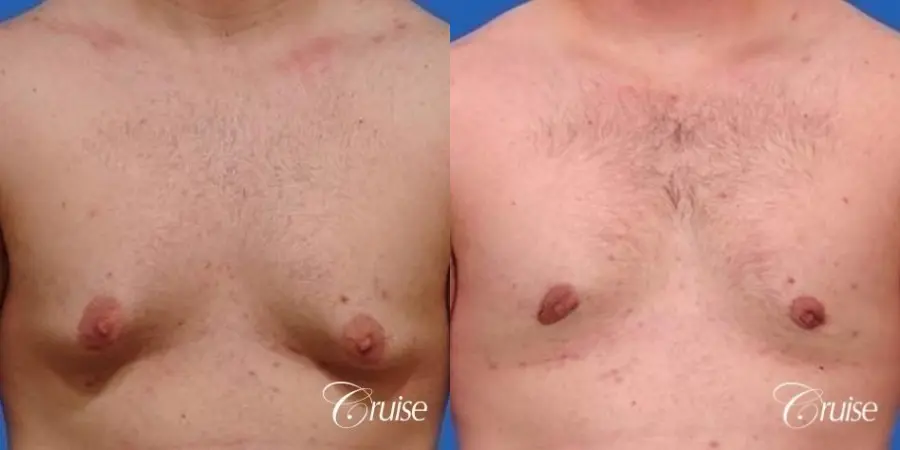 mild gynecomastia with puffy nipple on adult - Before and After 1