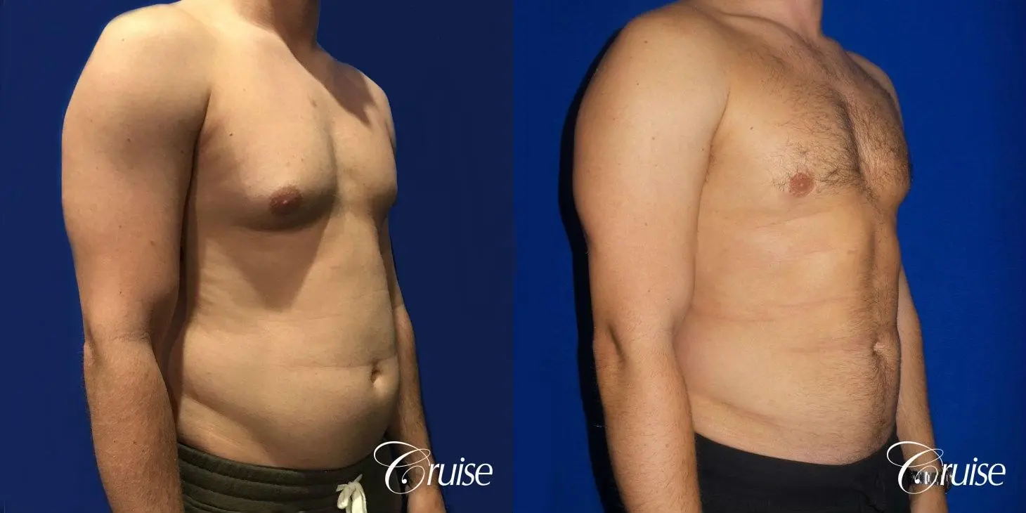 Type 2/3 Asymmetric Gynecomastia  - Before and After 4