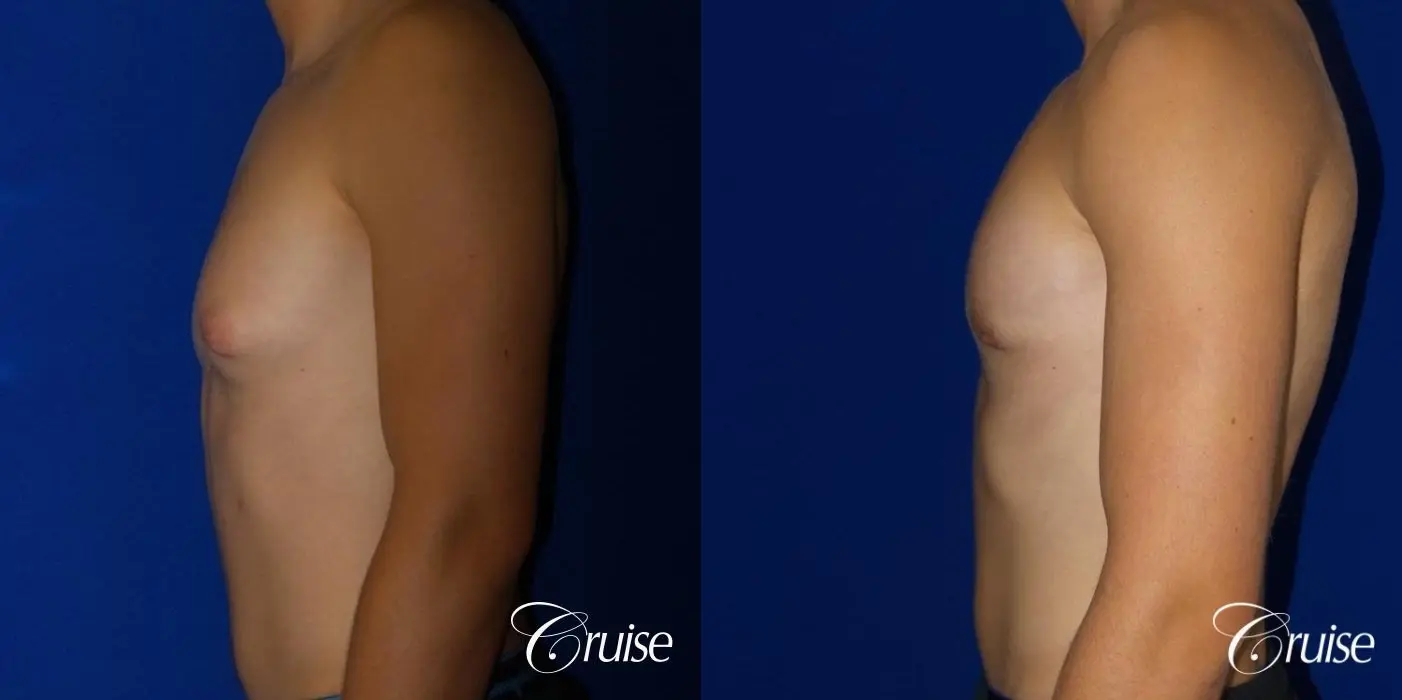 Mild Gynecomastia -Areola Incision - Before and After 3