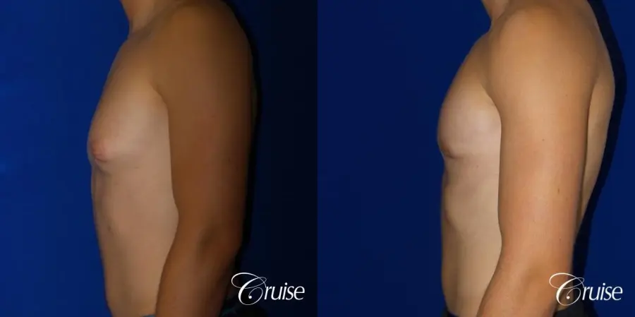 Mild Gynecomastia -Areola Incision - Before and After 3
