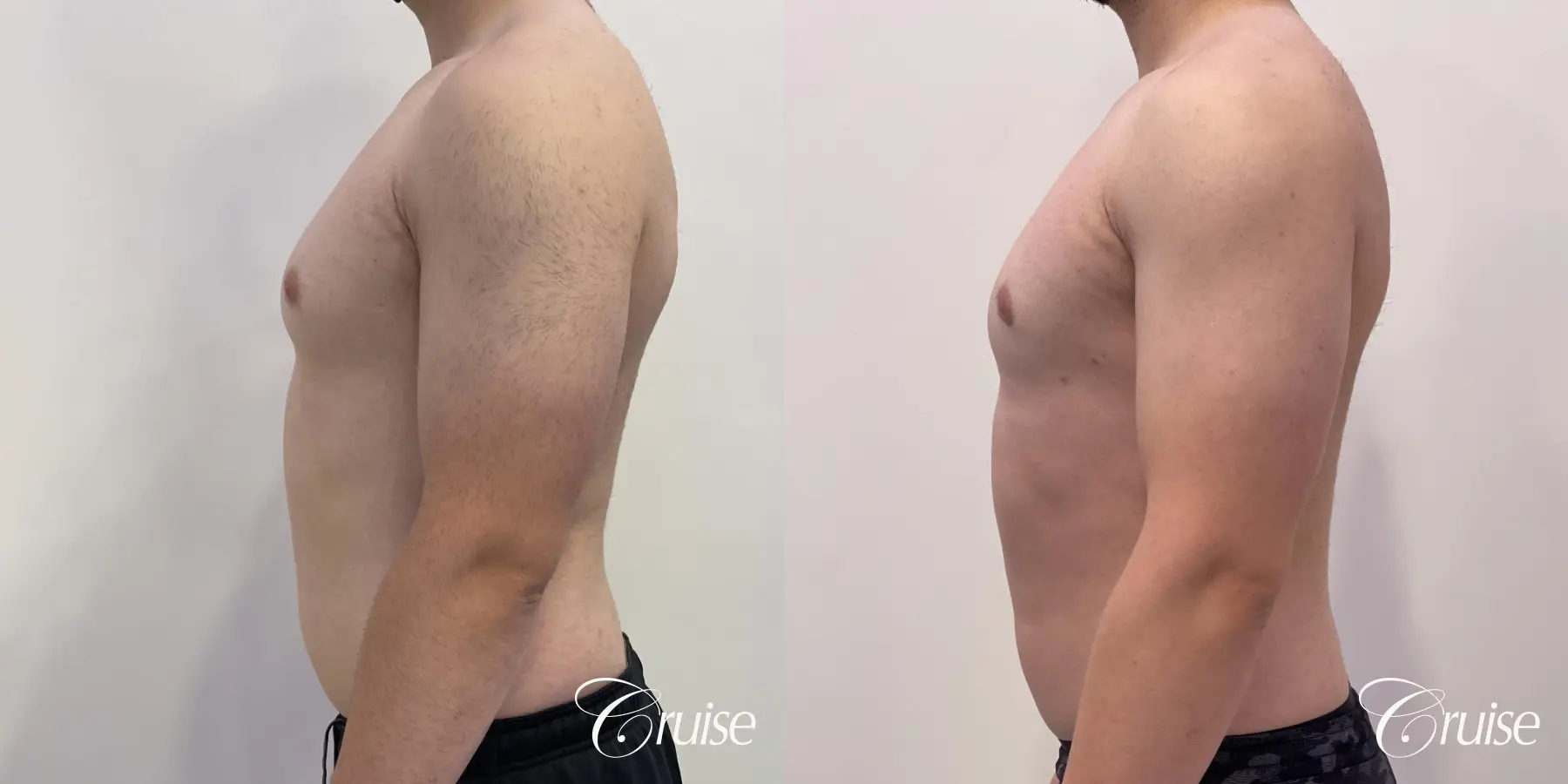 Gynecomastia: Patient 127 - Before and After 3