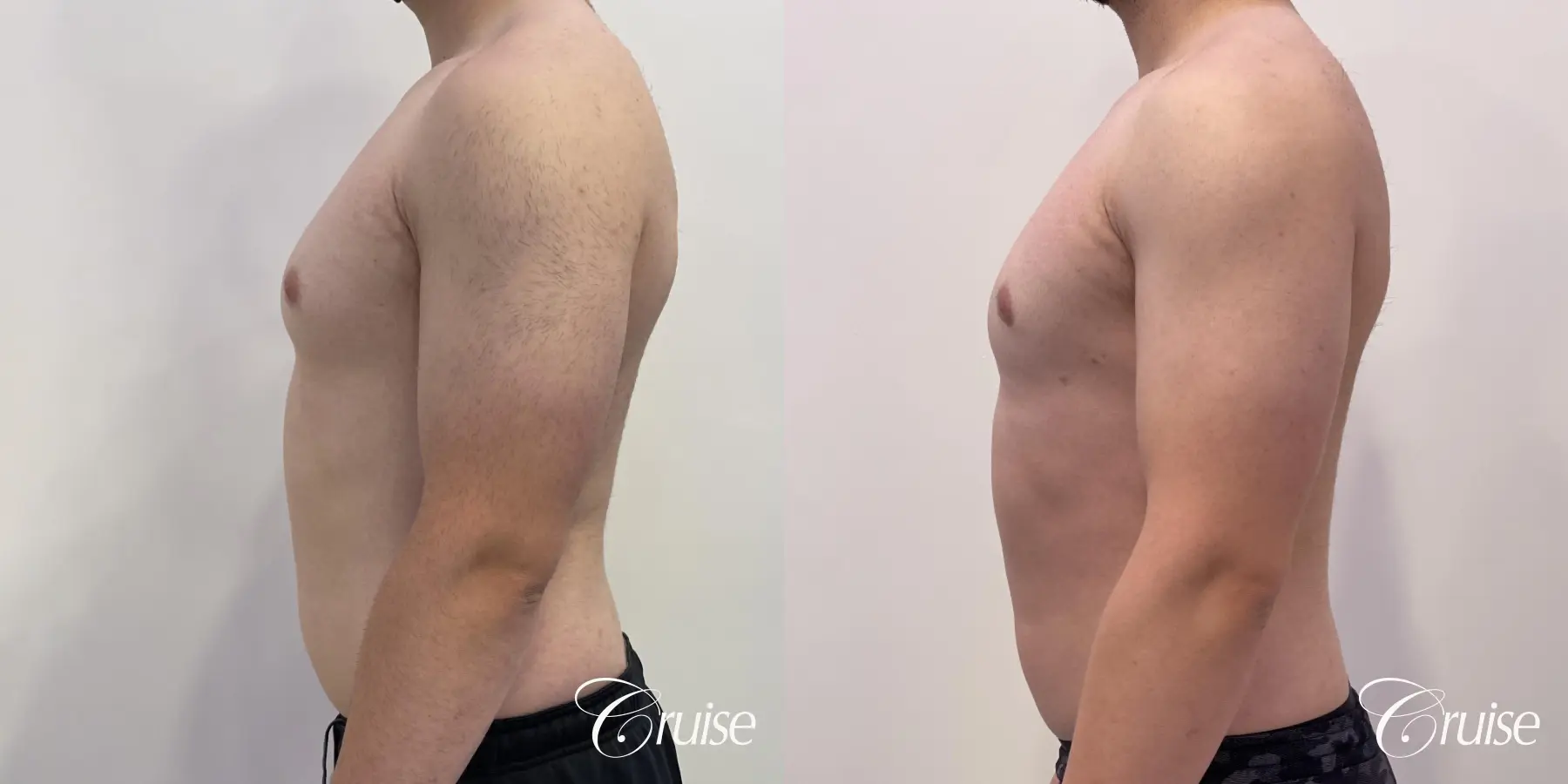 Gynecomastia: Patient 129 - Before and After 3