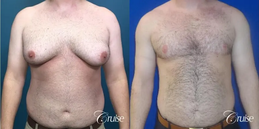 Severe Gynecomastia- Free nipple Graft - Before and After 1
