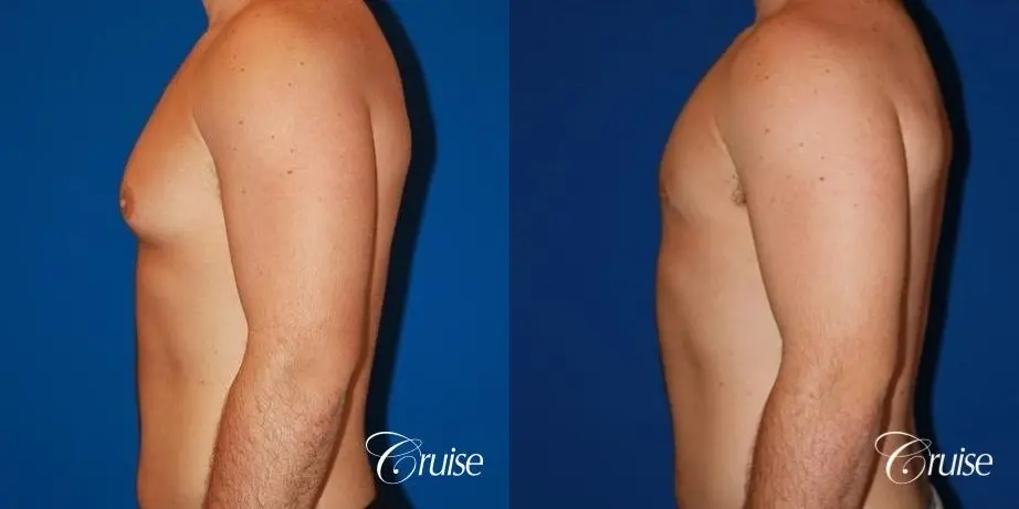 athletic adult with puffy nipple - Before and After 2