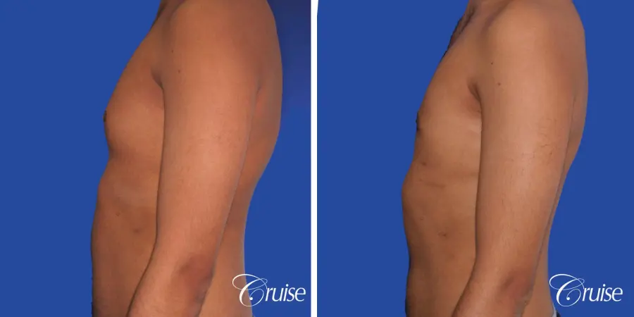 best before and after results for gynecomastia surgery - Before and After 2