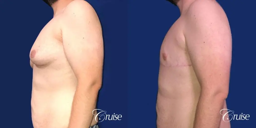 Pedicle incision Dr. Cruise Newport Beach CA - Before and After 2