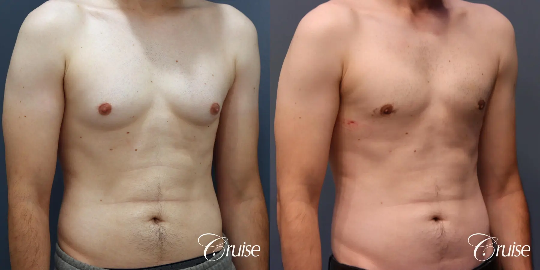 Gynecomastia: Patient 140 - Before and After 4