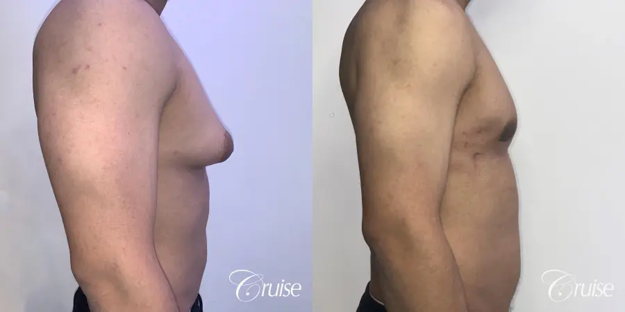 gynecomastia surgery - Before and After 4
