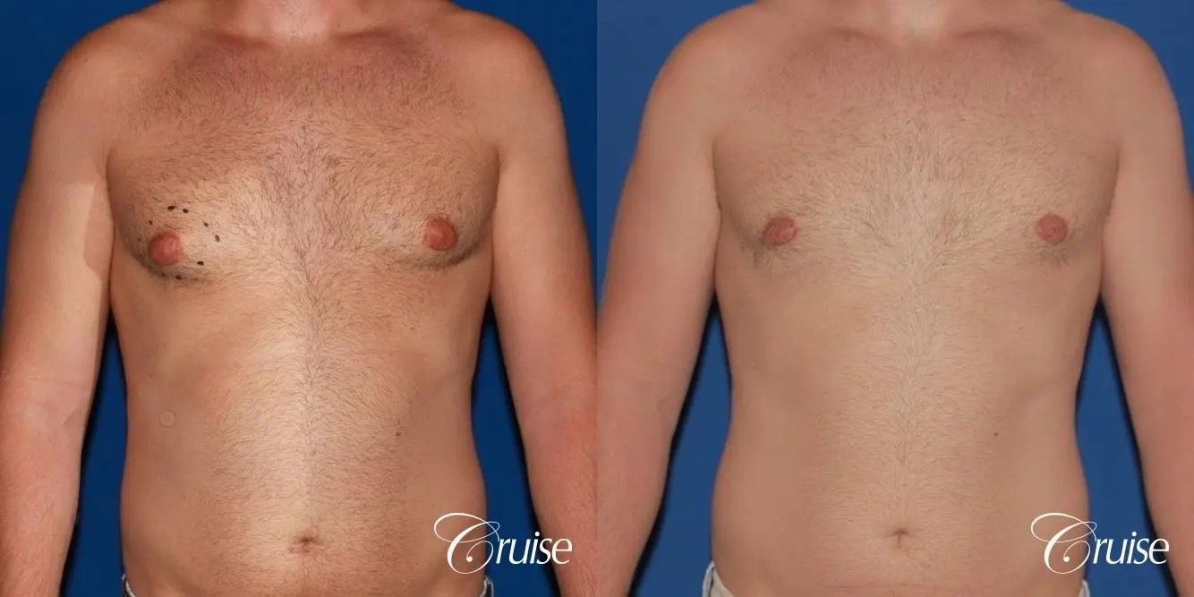 best puffy nipple surgery correction - Before and After 1