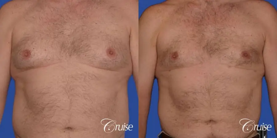 chest liposuction on adult - Before and After 1