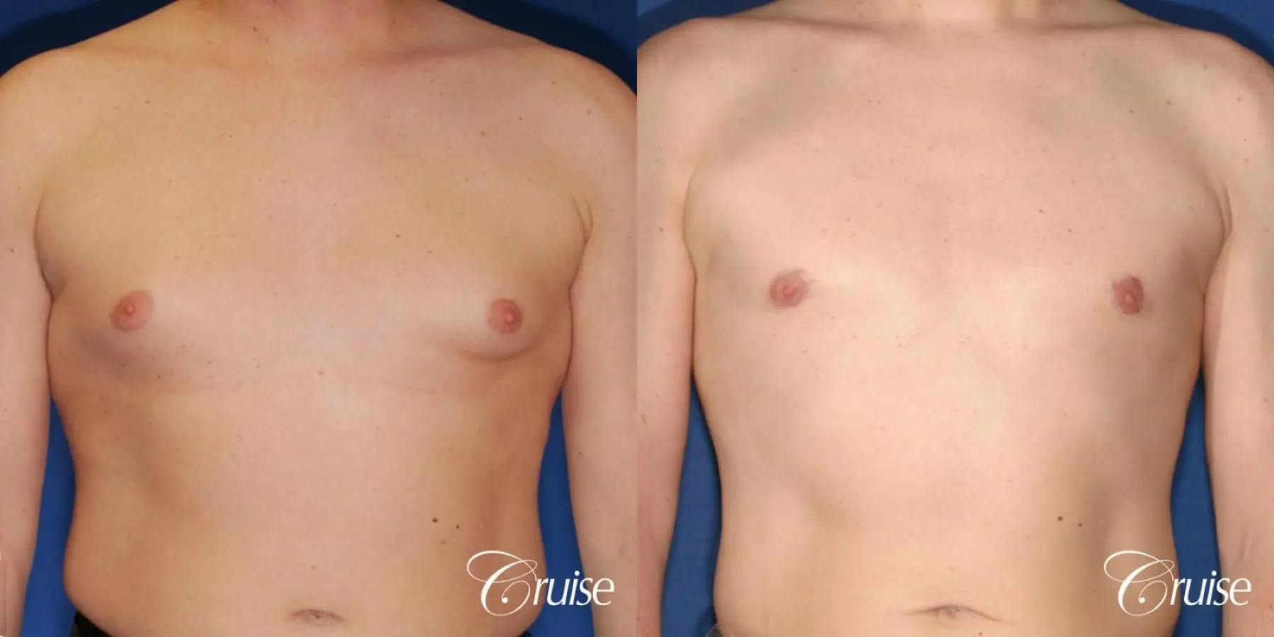 moderate gynecomastia on adult with donut lift scar - Before and After 1
