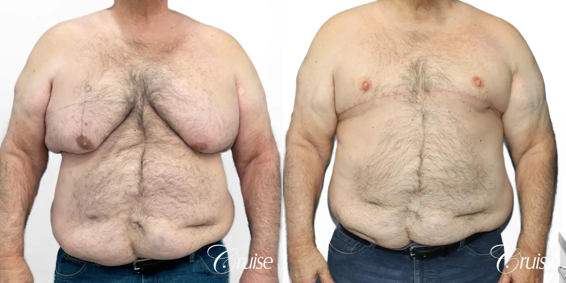 Gynecomastia: Patient 147 - Before and After 1