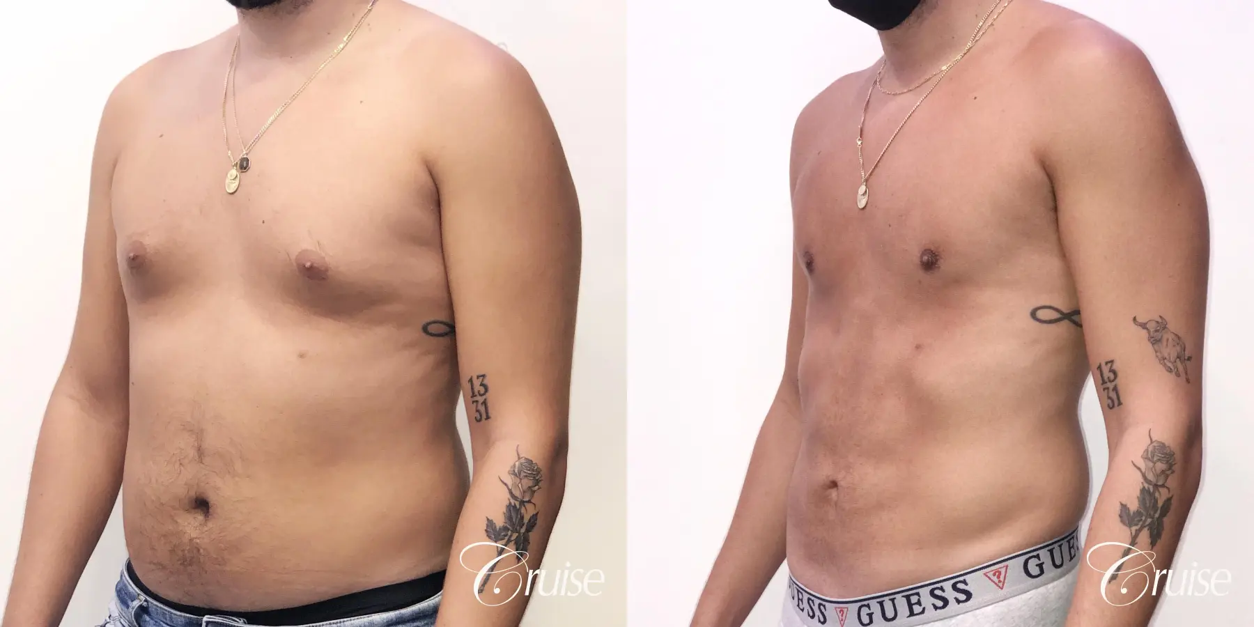 gynecomastia correction orange county - Before and After 3
