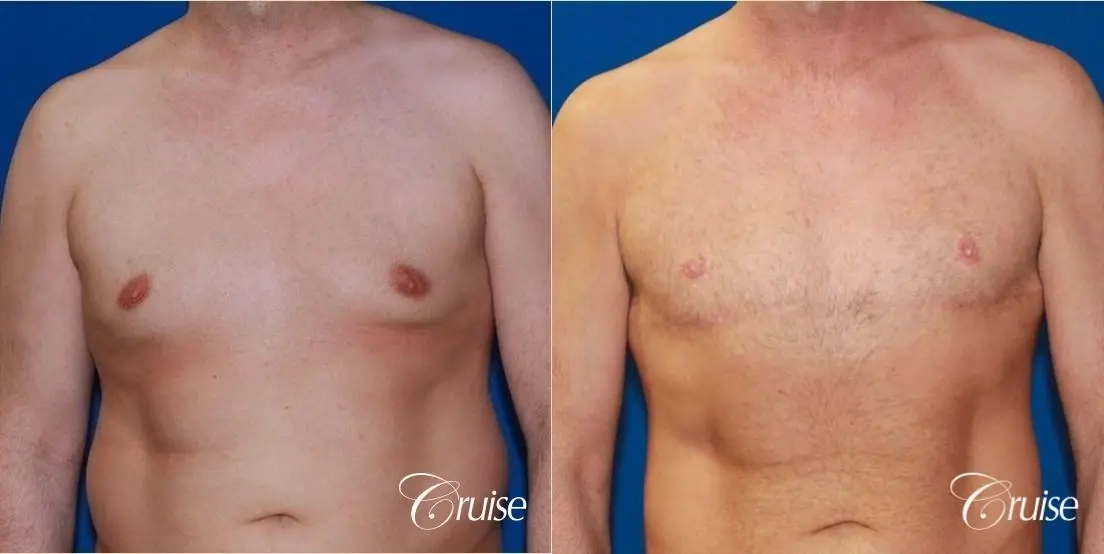Free Nipple Graft male gynecomastia - Before and After 1