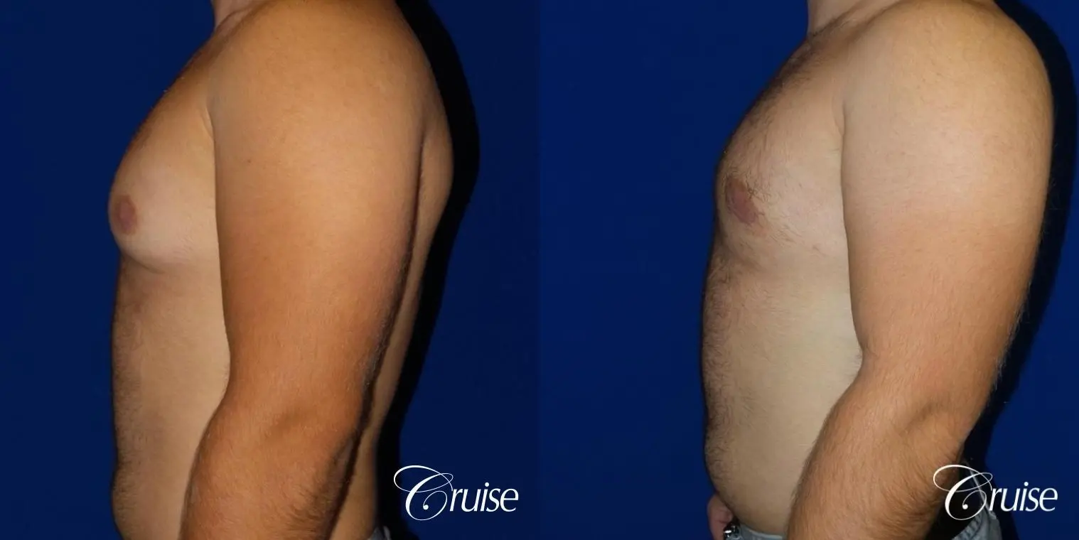 best gynecomastia results - Before and After 3