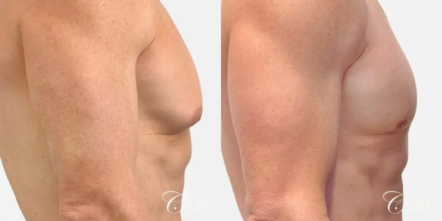 gynecomastia removal - Before and After 3