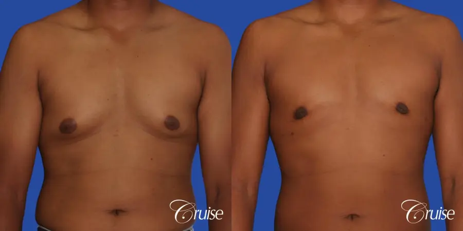 24 yr. old gets gynecomastia surgery with best scars - Before and After 1