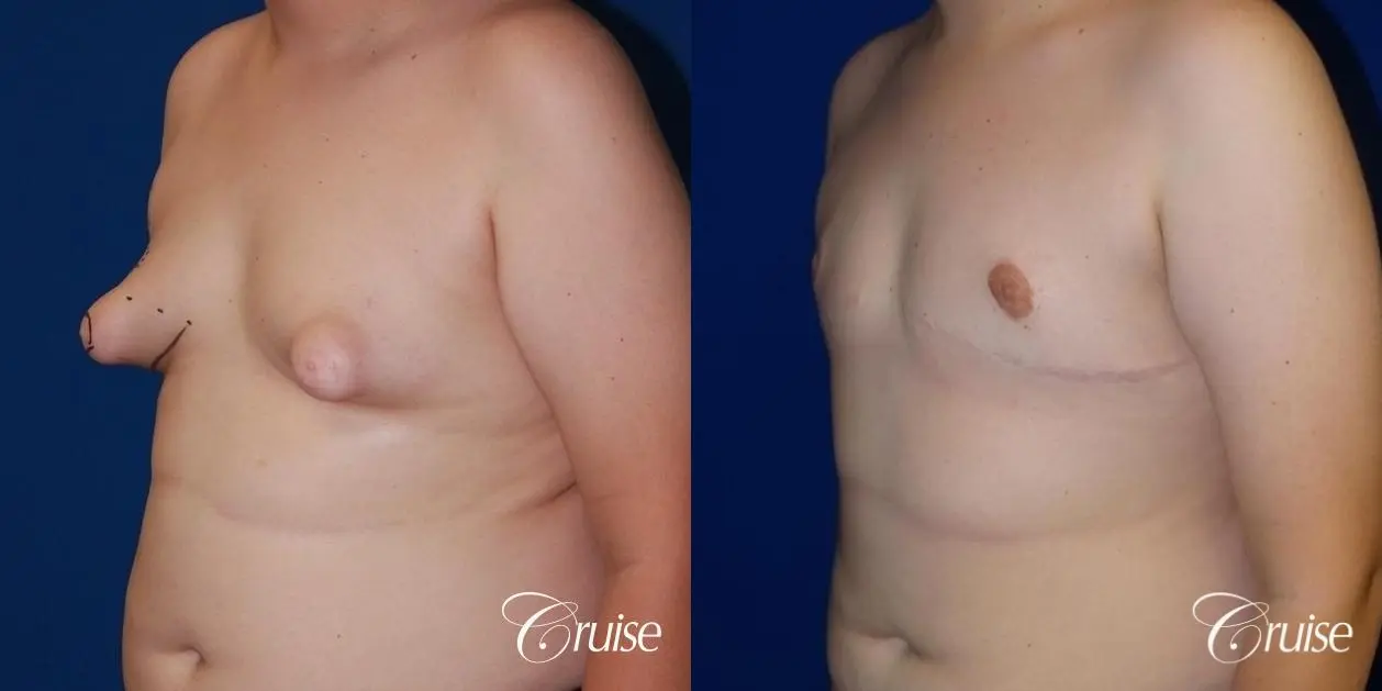 young boy with gynecomastia during puberty gets surgery - Before and After 2