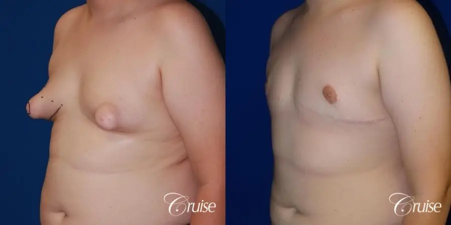 young boy with gynecomastia during puberty gets surgery - Before and After 2