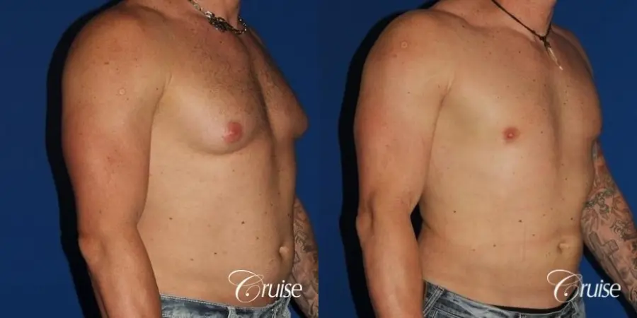 Athletic adult gynecomastia with glandular tissue removal - Before and After 4